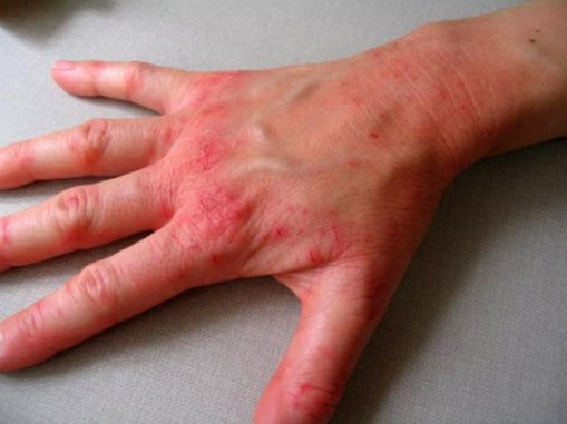Image result for професійна алергія